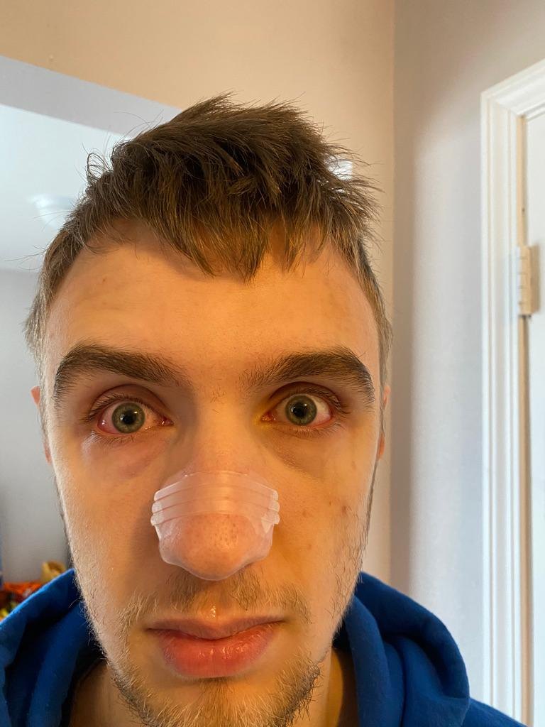 Alexander after 2 months of mold exposure